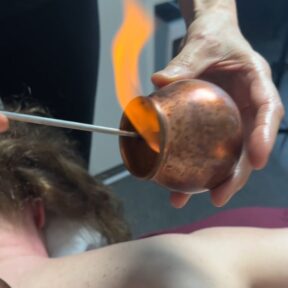 Cupping Therapy